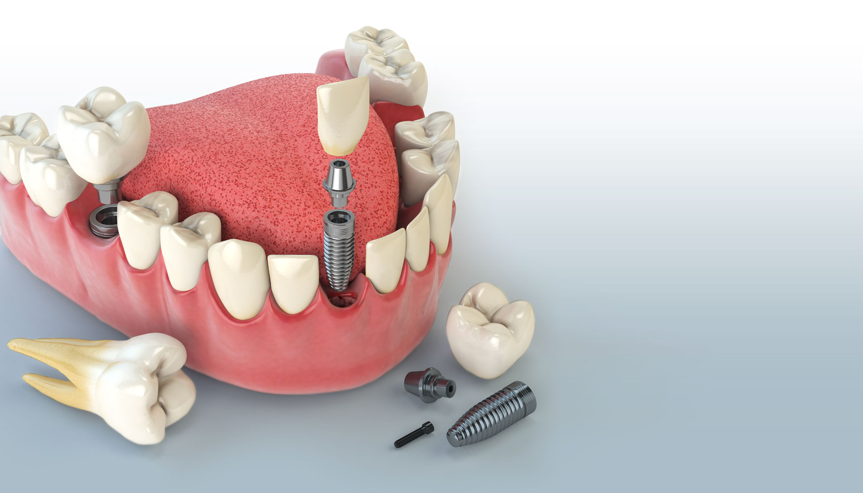dentalimplantintheaestheticzonemodel The Facial & Oral Surgery