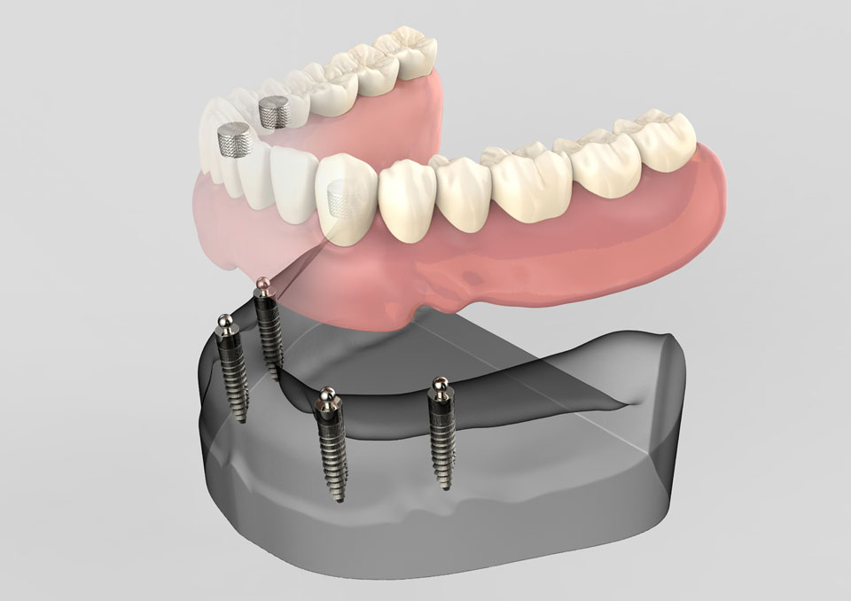 full arch dental implants model Fargo, ND