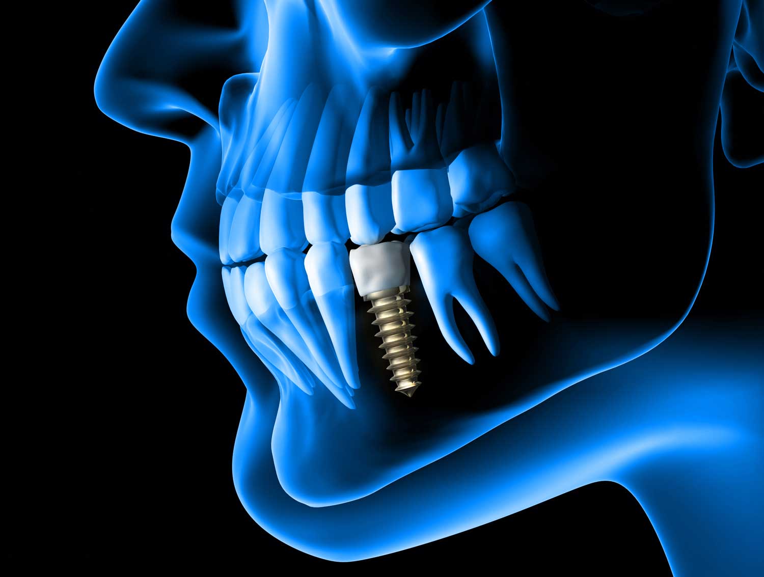 How To Care For And Maintain Your Dental Implants