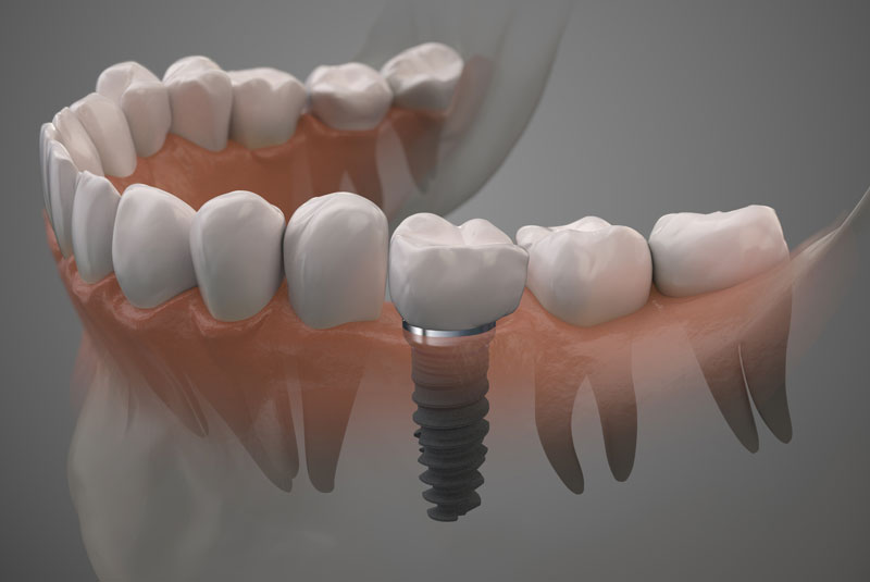 Graphic Model Of Implant