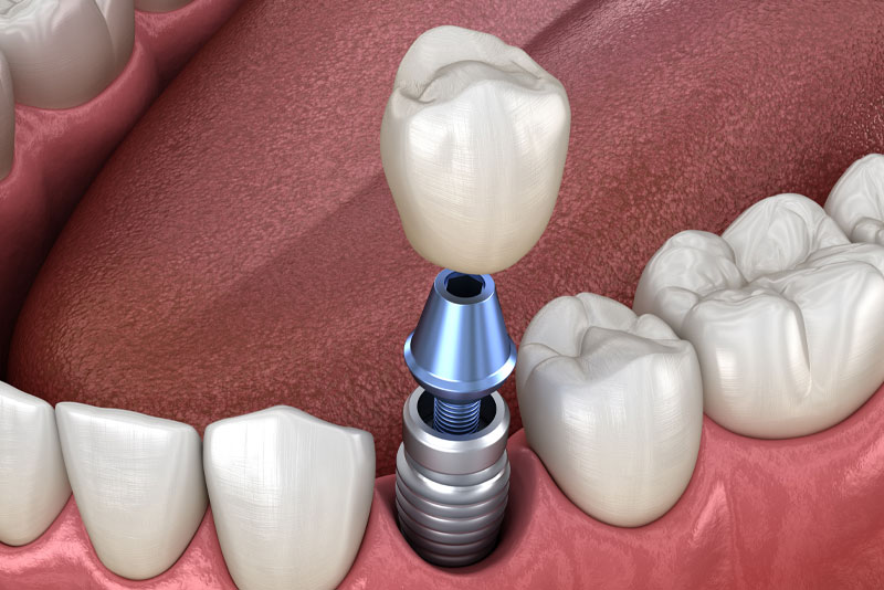 Dental Implant Model In Gums