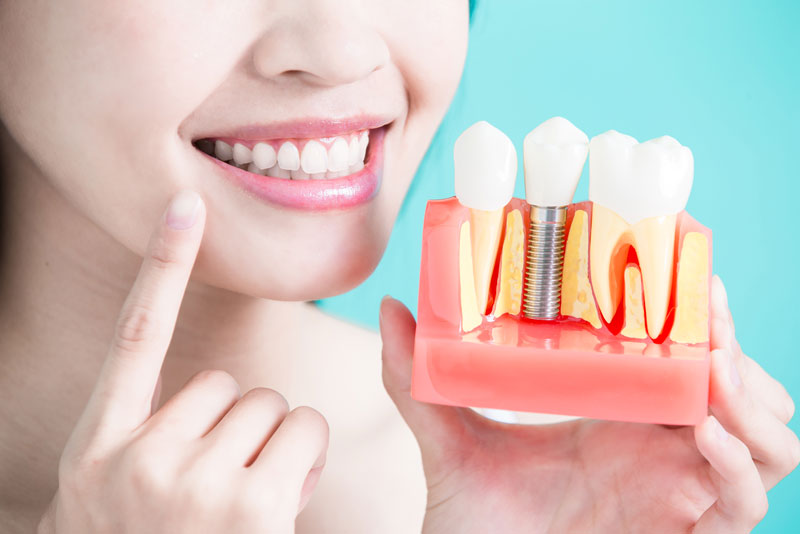 Dental Patient Holding Dental Implant Model