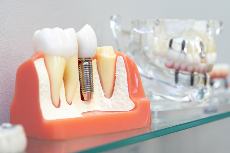 Dental Implants Albany Ny